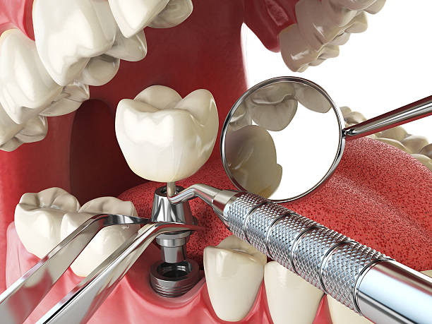 Best Chipped Tooth Repair Near Me  in Wright, WY